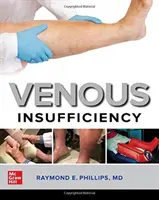 Insuficiența venoasă - Venous Insufficiency
