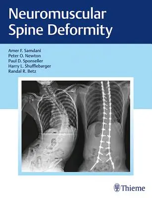 Deformarea neuromusculară a coloanei vertebrale - Neuromuscular Spine Deformity