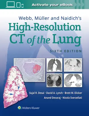 CT de înaltă rezoluție a plămânului de Webb, Mller și Naidich - Webb, Mller and Naidich's High-Resolution CT of the Lung