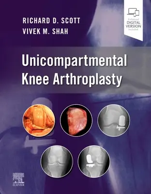 Artroplastia unicompartimentală a genunchiului - Unicompartmental Knee Arthroplasty