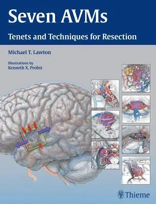 Șapte Avms: Principii și tehnici pentru rezecție - Seven Avms: Tenets and Techniques for Resection