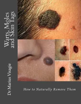 Negii, alunițele și petele de piele: Cum să le eliminați în mod natural - Warts, Moles and Skin Tags: How to Naturally Remove Them