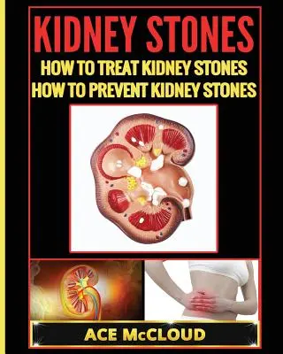Pietrele la rinichi: Cum să tratezi pietrele la rinichi: Cum să preveniți pietrele la rinichi - Kidney Stones: How To Treat Kidney Stones: How To Prevent Kidney Stones