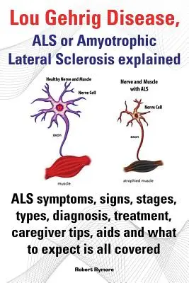 Boala Lou Gehrig, ALS sau scleroza laterală amiotrofică explicată. ALS Simptome, semne, etape, tipuri, diagnostic, tratament, sfaturi pentru îngrijitori, SIDA și - Lou Gehrig Disease, ALS or Amyotrophic Lateral Sclerosis Explained. ALS Symptoms, Signs, Stages, Types, Diagnosis, Treatment, Caregiver Tips, AIDS and