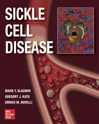 Boala celulelor falciforme - Sickle Cell Disease