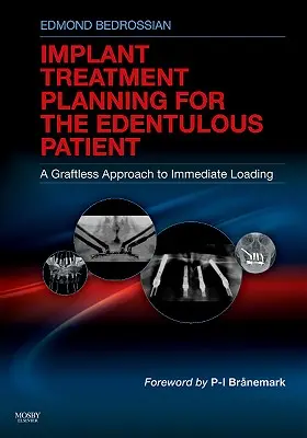 Planificarea tratamentului cu implanturi pentru pacientul edentat: O abordare fără grefă a încărcării imediate - Implant Treatment Planning for the Edentulous Patient: A Graftless Approach to Immediate Loading