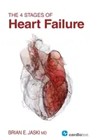 Cele 4 stadii ale insuficienței cardiace - The 4 Stages of Heart Failure