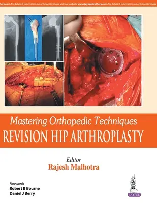 Stăpânirea tehnicilor ortopedice: Artroplastia totală de șold de revizie - Mastering Orthopedic Techniques: Revision Total Hip Arthroplasty