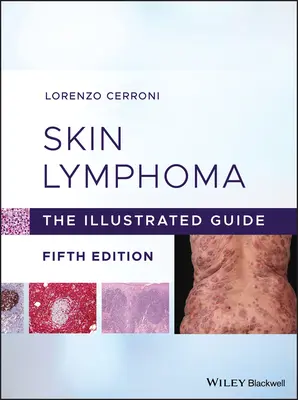 Limfomul cutanat: Ghidul ilustrat - Skin Lymphoma: The Illustrated Guide