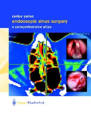 Endoscopic Sinus Surgery: Un atlas cuprinzător - Endoscopic Sinus Surgery: A Comprehensive Atlas