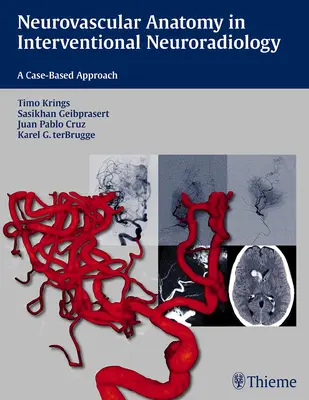 Anatomia neurovasculară în neuroradiologia intervențională: O abordare bazată pe cazuri - Neurovascular Anatomy in Interventional Neuroradiology: A Case-Based Approach