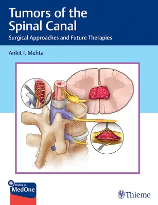 Tumori ale canalului spinal: Abordări chirurgicale și terapii viitoare - Tumors of the Spinal Canal: Surgical Approaches and Future Therapies