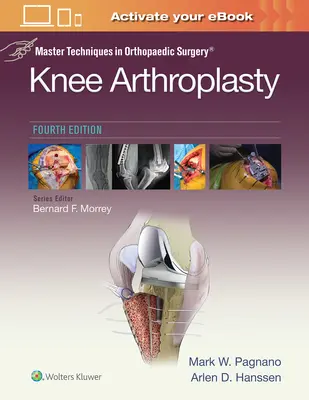 Tehnici de bază în chirurgia ortopedică: Artroplastia genunchiului - Master Techniques in Orthopedic Surgery: Knee Arthroplasty