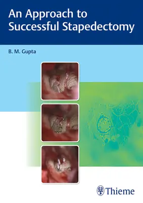 O abordare a stapedectomiei de succes - An Approach to Successful Stapedectomy