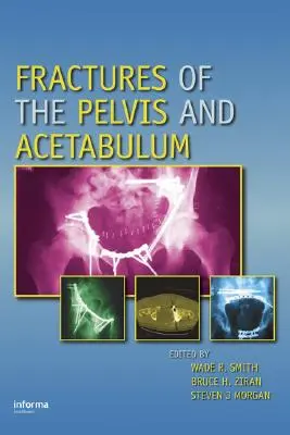 Fracturi ale pelvisului și ale acetabulului - Fractures of the Pelvis and Acetabulum