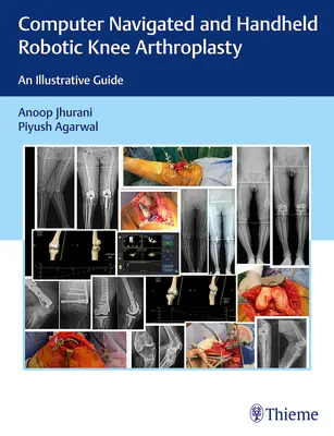 Artroplastia genunchiului robotizată, navigată de calculator și manuală: Un ghid ilustrativ - Computer Navigated and Handheld Robotic Knee Arthroplasty: An Illustrative Guide