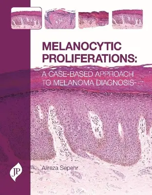 Proliferări melanocitare - O abordare bazată pe cazuri pentru diagnosticarea melanomului - Melanocytic Proliferations - A Case-Based Approach to Melanoma Diagnosis