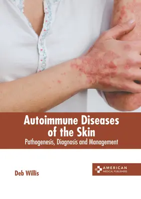 Boli autoimune ale pielii: Patogeneză, diagnostic și management - Autoimmune Diseases of the Skin: Pathogenesis, Diagnosis and Management
