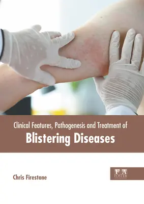 Caracteristicile clinice, patogeneza și tratamentul bolilor veziculoase - Clinical Features, Pathogenesis and Treatment of Blistering Diseases
