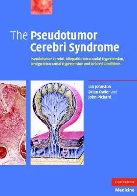 Sindromul Pseudotumor Cerebri - The Pseudotumor Cerebri Syndrome