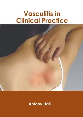 Vasculita în practica clinică - Vasculitis in Clinical Practice
