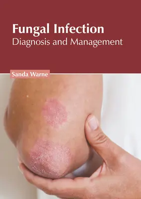 Infecția fungică: Diagnostic și management - Fungal Infection: Diagnosis and Management