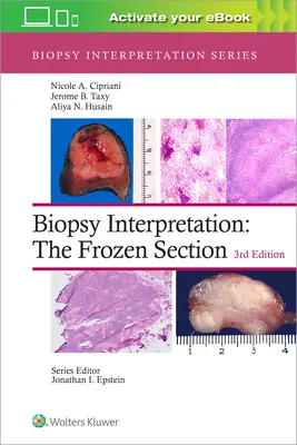 Interpretarea biopsiei: Secțiunea congelată - Biopsy Interpretation: The Frozen Section