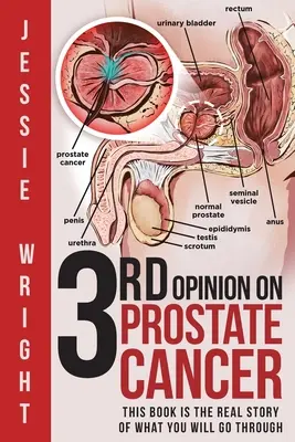 A treia opinie privind cancerul de prostată - 3rd Opinion on Prostate Cancer