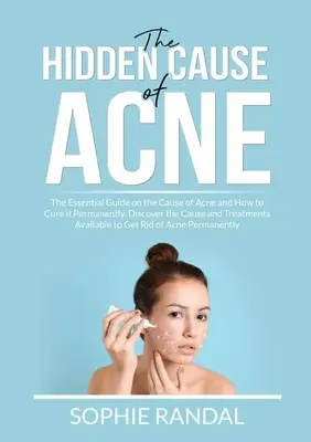 Cauza ascunsă a acneei: Ghidul esențial despre cauza acneei și cum să o vindeci permanent, Descoperă cauza și tratamentele disponibile t - The Hidden Cause of Acne: The Essential Guide on the Cause of Acne and How to Cure it Permanently, Discover the Cause and Treatments Available t
