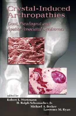 Artropatii induse de cristale: Guta, pseudoguta și sindroamele asociate cu apatita - Crystal-Induced Arthropathies: Gout, Pseudogout and Apatite-Associated Syndromes