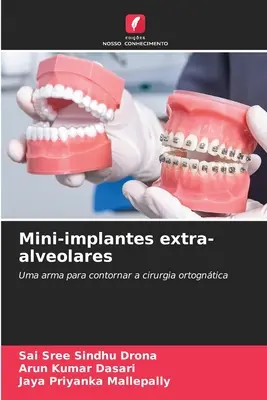 Mini-implante extra-alveolare - Mini-implantes extra-alveolares