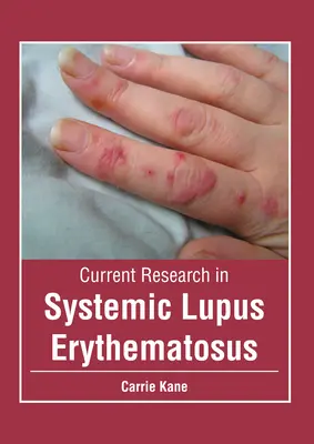 Cercetări actuale în lupusul eritematos sistemic - Current Research in Systemic Lupus Erythematosus