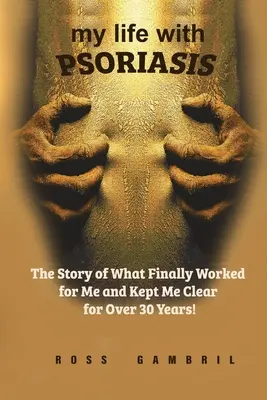 Viața mea cu PSORIASIS: Povestea a ceea ce a funcționat în cele din urmă pentru mine și m-a menținut curată timp de peste 30 de ani! - my life with PSORIASIS: The story of what finally worked for me and kept me clear for over 30 years!
