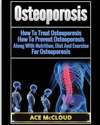 Osteoporoza: Cum Să Tratăm Osteoporoza: Cum Să Prevenim Osteoporoza: Împreună cu nutriția, dieta și exercițiile fizice pentru osteoporoză - Osteoporosis: How To Treat Osteoporosis: How To Prevent Osteoporosis: Along With Nutrition, Diet And Exercise For Osteoporosis