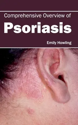 Prezentare cuprinzătoare a psoriazisului - Comprehensive Overview of Psoriasis