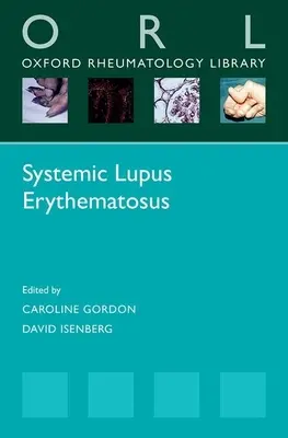 Lupus eritematos sistemic - Systemic Lupus Erythematosus