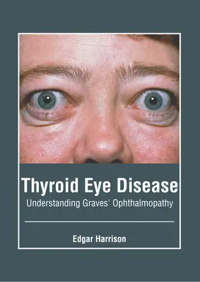 Boala tiroidiană a ochilor: Înțelegerea oftalmopatiei Graves - Thyroid Eye Disease: Understanding Graves' Ophthalmopathy