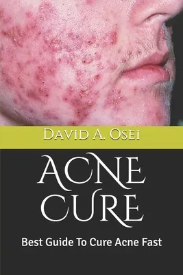 Cura De Acnee: Cel Mai Bun Ghid Pentru A Vindeca Acneea Rapid - Acne Cure: Best Guide To Cure Acne Fast