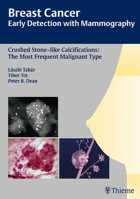 Cancerul de sân: Early Detection with Mammography: Crushed Stone-Like Calcifications: Cel mai frecvent tip malign [Cu CDROM] - Breast Cancer: Early Detection with Mammography: Crushed Stone-Like Calcifications: The Most Frequent Malignant Type [With CDROM]
