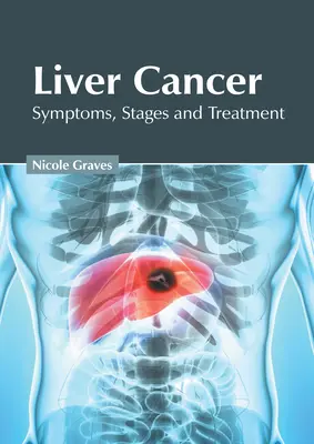Cancerul hepatic: Simptome, stadii și tratament - Liver Cancer: Symptoms, Stages and Treatment