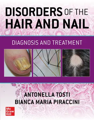 Tulburări ale părului și unghiilor: Diagnostic și tratament - Disorders of the Hair and Nail: Diagnosis and Treatment