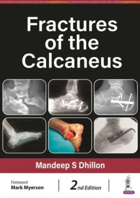 Fracturi ale calcanului - Fractures of the Calcaneus